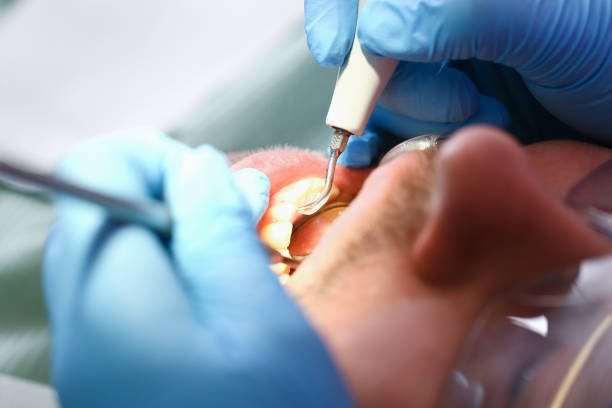 Best Chipped Tooth Repair Near Me  in Edgemoor, DE